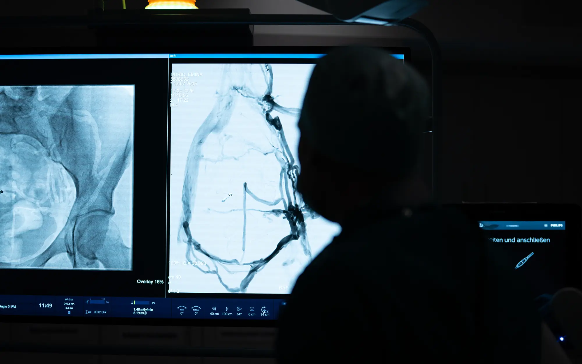 Bildgesteuerte Gefäßintervention im Angiographieraum